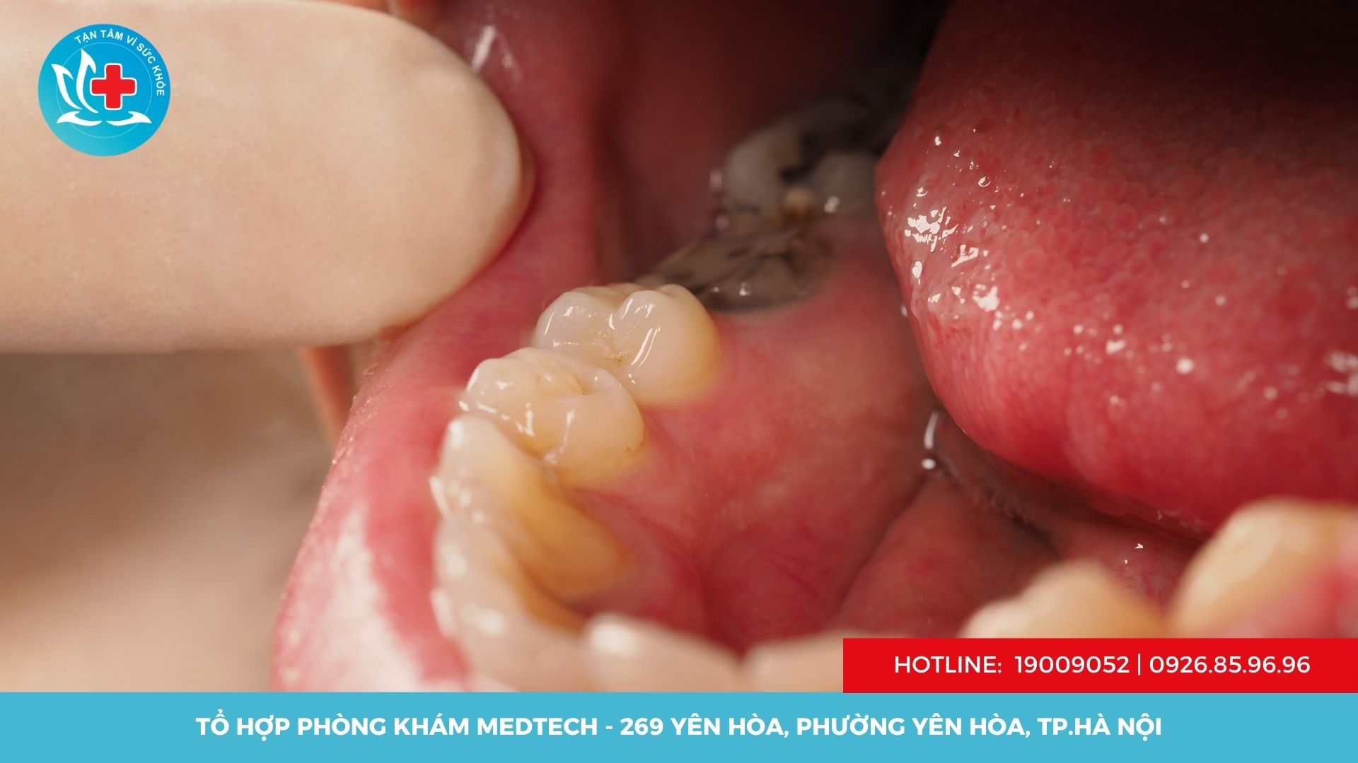 Hậu quả của việc trì hoãn điều trị bệnh răng miệng